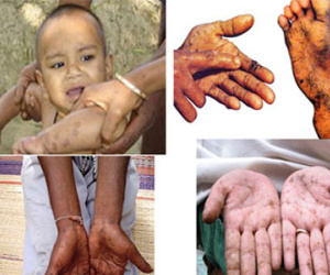 Những hình ảnh đáng sợ khi trẻ bị nhiễm độc chì