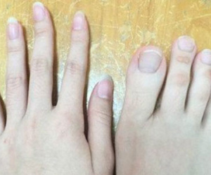 Nữ sinh bất ngờ nổi tiếng vì "ngón chân dài... như ngón tay"