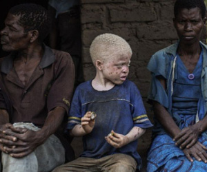Nạn săn người bạch tạng lấy xương man rợ ở Malawi