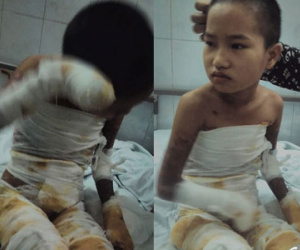 Ngã vào bếp lửa, bé gái bỏng nặng phải cắt 9 ngón tay