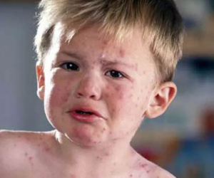 Điều cha mẹ nên biết để phòng thủy đậu cho bé trong mùa hè