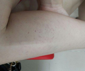 Cảnh báo căn bệnh nguy hiểm thường nhầm với sốt phát ban ở trẻ