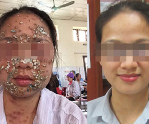 Người sưng phù, thay đổi cả hình dạng vì nhiễm giun sán
