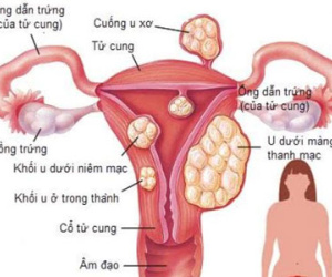 Nhiều phụ nữ bị u xơ tử cung mà không biết