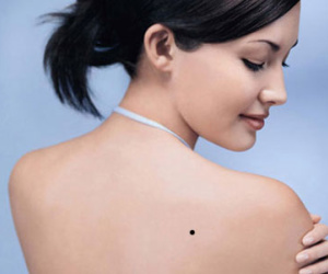 Mẹo nhìn nốt ruồi để biết ung thư hay không