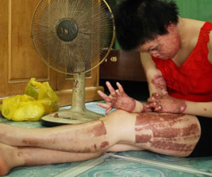 Người bị chồng tưới xăng đốt: Con thấy mặt tôi là khóc thét