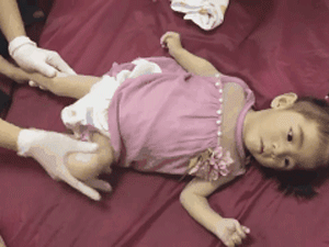 Bé gái Lào Cai 14 tháng tuổi chỉ nặng 3,5kg đang tập vật lý trị liệu và đã được 6,5kg