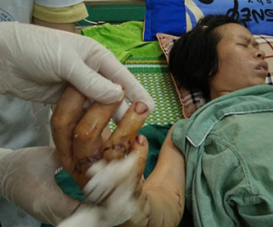 Rùng mình chồng chém vợ đứt lìa bàn tay