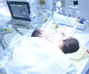 Cặp song sinh dính liền ở Hà Giang: Mẹ xuất viện thì con lìa đời