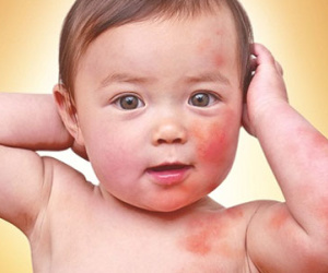 Dị ứng thức ăn ở trẻ và cách xử trí