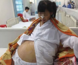 Mang khối u buồng trứng nặng 32kg vì không điều trị