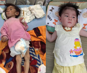 Yêu thương chính là điều kỳ diệu giúp bé gái 14 tháng nặng 3,5kg thay da đổi thịt như thế này!