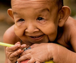 Bé 4 tuổi bị xa lánh vì có hình hài như ông lão 80