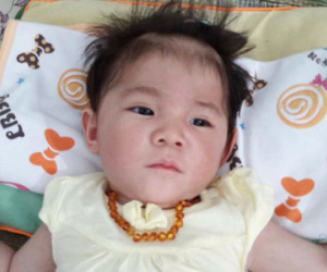 Thông tin mới nhất về em bé 14 tháng nặng 3,5kg ở Lào Cai