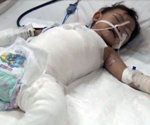 Mẹ đi vệ sinh, bé gái 2 tuổi bị cả nồi canh đang sôi đổ lên người
