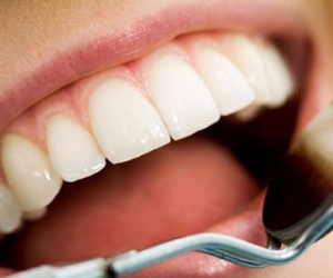 Thực hư việc lấy cao răng làm răng yếu đi