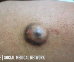 Hết hồn khối u “quái thú” giống như đôi mắt người