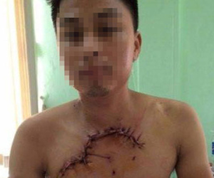 Hy hữu: Nam thanh niên ngã xe máy lòi tim phổi ra ngoài