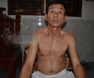 Bệnh nhân "phản pháo" GS hàng đầu mở bụng không cắt u