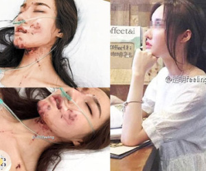 MC Trung Quốc bị tai nạn biến dạng mặt