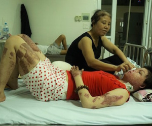 Cô gái bị chồng tưới xăng đốt phẫu thuật mở rộng miệng