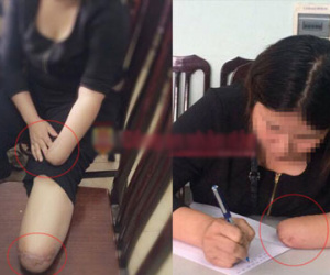 Hãi hùng lời thú nhận thuê chặt chân tay để trục lợi của cô gái trẻ
