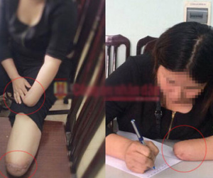 Vụ thuê chặt chân tay: Chỉ là 1 trong 8.000 vụ trục lợi bảo hiểm mỗi năm