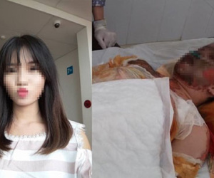 Cô gái xinh đẹp bị bỏng toàn thân, mặt biến dạng sau tai nạn