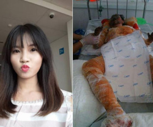 Bố của cô gái xinh đẹp bị bỏng nặng: “Con tôi bảo nó sợ cụt hết tay, thành dị dạng không ai dám đến gần”