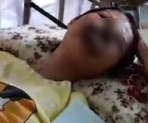 Cô gái ở Đồng Nai mắc bệnh lạ, khuôn mặt bị ăn mòn cả hàm trên và mũi