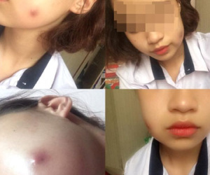 9X có nguy cơ thủng má vì đi spa làm lúm đồng tiền