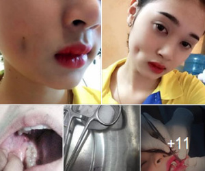 Cô gái trẻ xinh đẹp tố cơ sở thẩm mỹ giá rẻ làm má lúm đồng tiền hỏng khiến mặt bị biến dạng