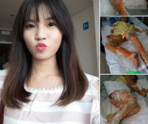 Cha hiến da ghép cho con gái bị bỏng nặng