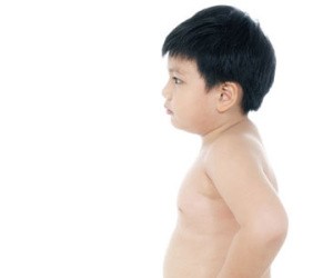 Trẻ 3 tuổi nặng gần 18 kg làm sao giảm cân