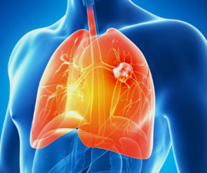 Ngừa ung thư phổi, detox chỉ 3 ngày