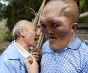 Người đàn ông mặc cảm vì khuôn mặt dị dạng như người ngoài hành tinh