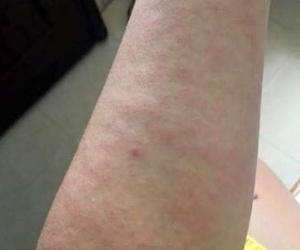 Cẩn trọng bệnh da do đi mưa và lội nước ngập