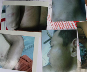 Dân tố bị Trưởng Công an xã đánh trọng thương vì dắt xe vô chủ