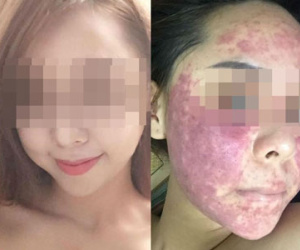 Cô gái chịu hậu quả nặng nề sau khi dùng kem thảo dược