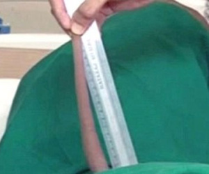 "Cậu bé thần khỉ" được cắt đuôi dài 18cm vì không ngồi được