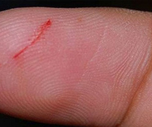 Tử vong vì một vết xước ở tay: Cảnh báo căn bệnh "giết" nhiều người hơn cả ung thư và AIDS