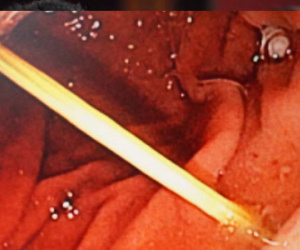 Ăn bánh canh Trảng Bàng, nuốt luôn tăm xỉa răng dài gần 7cm vô bao tử