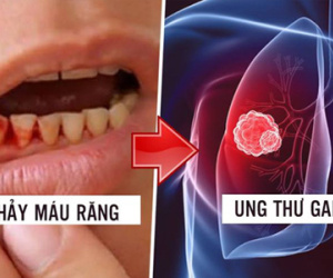 Bệnh nhân ung thư ân hận vì đã lơ là dấu hiệu chảy máu chân răng