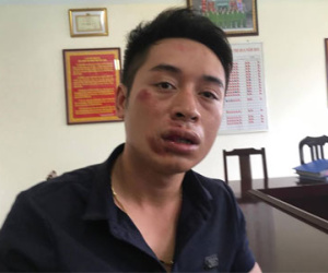 Hà Nội: Trung úy CSGT bị đánh gãy răng
