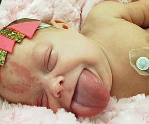 Bé gái chào đời với chiếc lưỡi khổng lồ to gấp đôi của người lớn