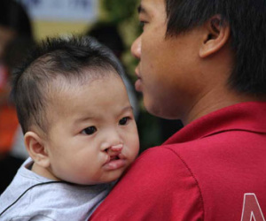 Phẫu thuật miễn phí cho 500 trẻ em bị hở môi hàm ếch
