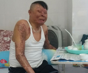 Chiến sĩ duy nhất còn sống sau vụ rơi máy bay ở Hòa Lạc sắp ra viện