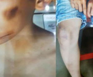 Bé trai 12 tuổi bị mẹ kế và bố đẻ đánh bằng chày: “Cháu phải đứng từ 10h tối đến sáng hôm sau”