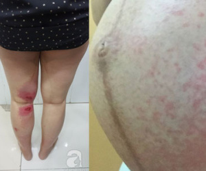 Một sản phụ chân bỏng rát, nổi nhiều bóng nước, bụng nổi ban do nghi bị kiến ba khoang cắn