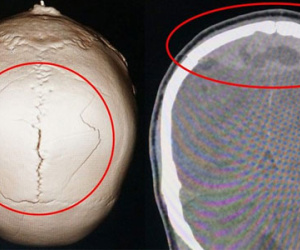 Bệnh nhân nứt sọ, tụ máu não 2 ngày mà không hay biết
